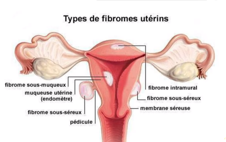 La dysménorrhée: quand les règles sont douloureuses